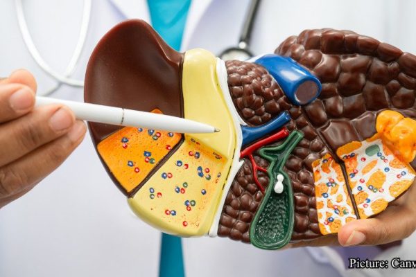 GNN New Blood Test Score Detects Hidden Alcohol Related Liver Disease